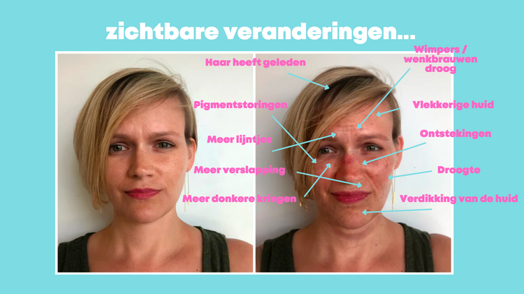 La colline kuren voor het herstel van zonneschade.